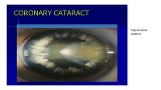 Supranuclear
cataract
 
