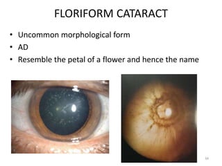 Congenital cataract