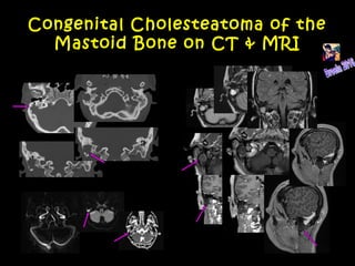 Congenital Cholesteatoma of the
Mastoid Bone on CT & MRI
 