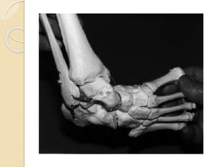 Congenital clubfoot | PPTX