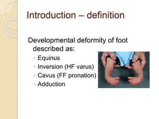Congenital Clubfoot