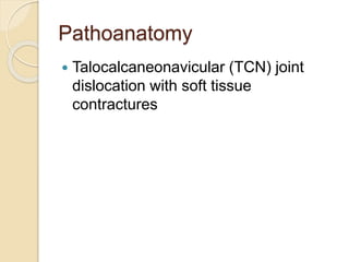 Congenital Clubfoot Congenital Clubfoot