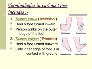 a brief explaination about congenital club foot.ppt