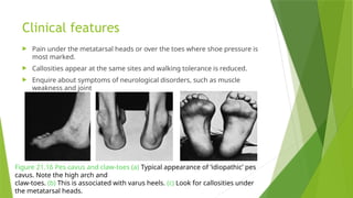 Specific Callosities CONGENITAL DEFORMITIES OF FOOT-1.pptx ppt | PPTX