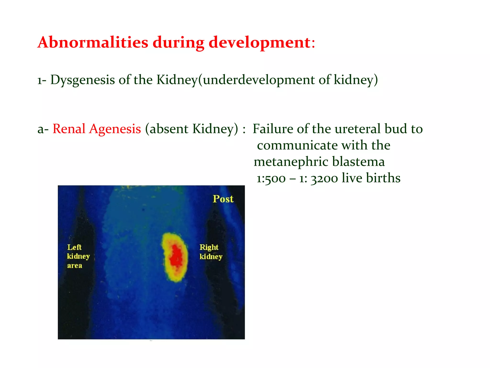 Abnormalities during development:
1- Dysgenesis of the Kidney(underdevelopment of kidney)
a- Renal Agenesis (absent Kidney) : Failure of the ureteral bud to
communicate with the
metanephric blastema
1:500 – 1: 3200 live births
 