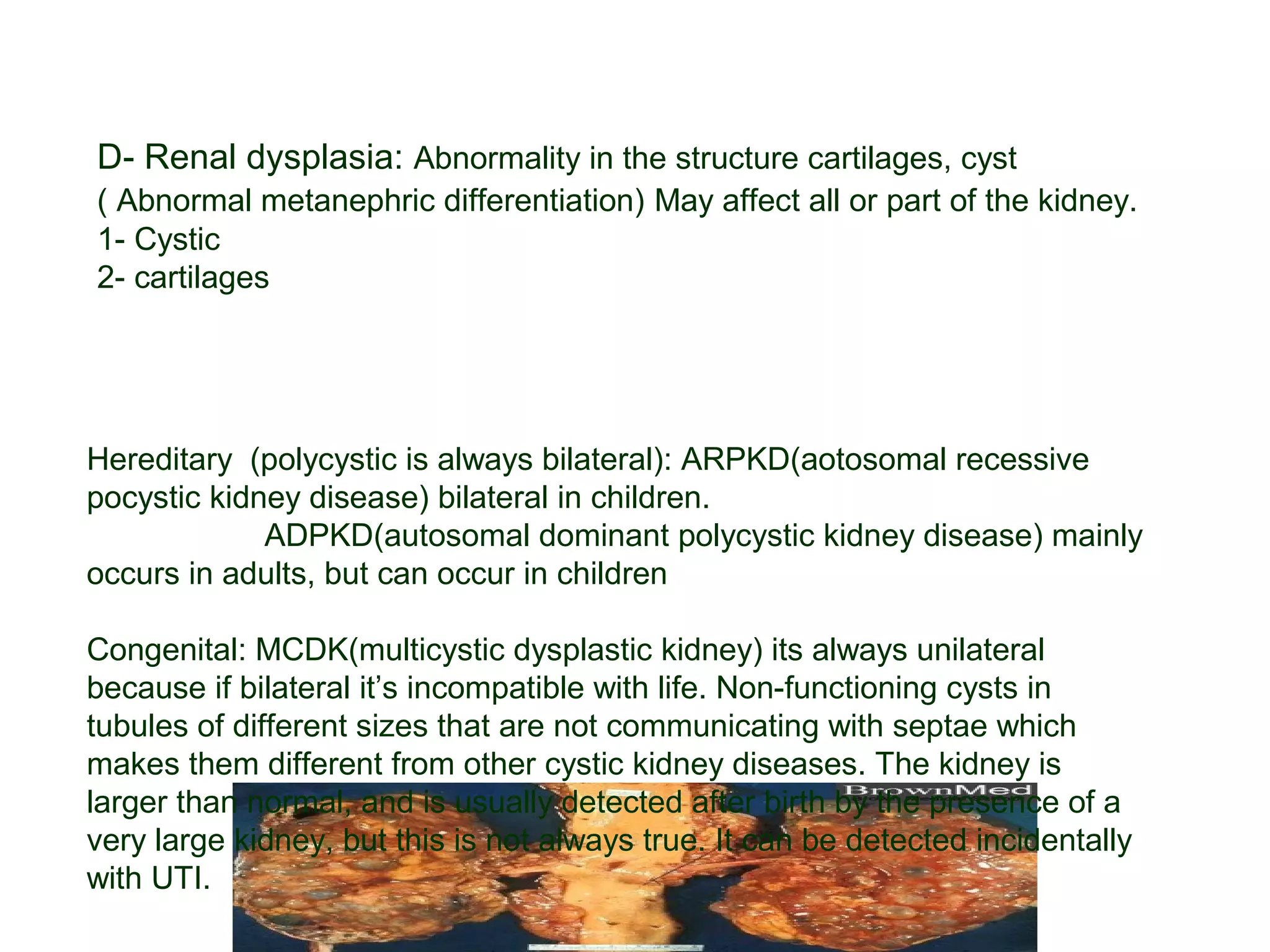 D- Renal dysplasia: Abnormality in the structure cartilages, cyst
( Abnormal metanephric differentiation) May affect all or part of the kidney.
1- Cystic
2- cartilages
Hereditary (polycystic is always bilateral): ARPKD(aotosomal recessive
pocystic kidney disease) bilateral in children.
ADPKD(autosomal dominant polycystic kidney disease) mainly
occurs in adults, but can occur in children
Congenital: MCDK(multicystic dysplastic kidney) its always unilateral
because if bilateral it’s incompatible with life. Non-functioning cysts in
tubules of different sizes that are not communicating with septae which
makes them different from other cystic kidney diseases. The kidney is
larger than normal, and is usually detected after birth by the presence of a
very large kidney, but this is not always true. It can be detected incidentally
with UTI.
 