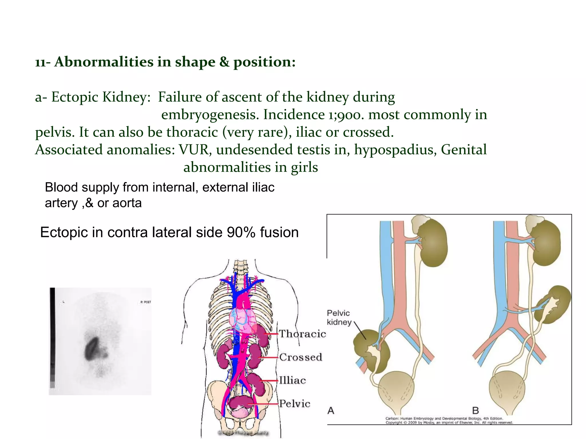 11- Abnormalities in shape & position:
a- Ectopic Kidney: Failure of ascent of the kidney during
embryogenesis. Incidence 1;900. most commonly in
pelvis. It can also be thoracic (very rare), iliac or crossed.
Associated anomalies: VUR, undesended testis in, hypospadius, Genital
abnormalities in girls
Blood supply from internal, external iliac
artery ,& or aorta
Ectopic in contra lateral side 90% fusion
 