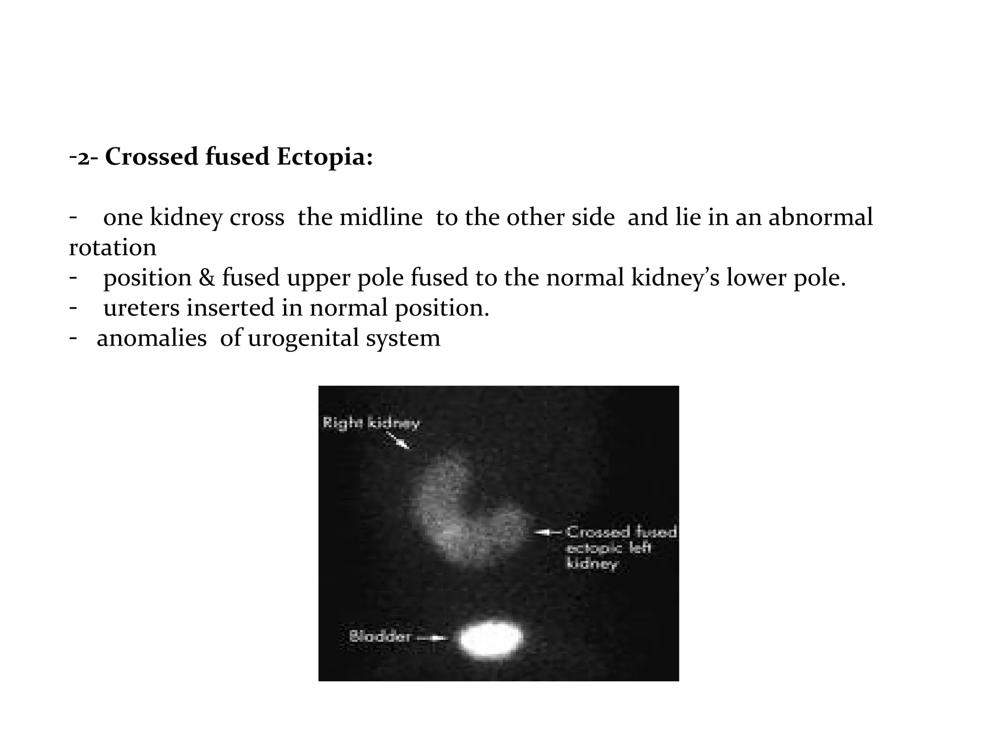 -2- Crossed fused Ectopia:
- one kidney cross the midline to the other side and lie in an abnormal
rotation
- position & fused upper pole fused to the normal kidney’s lower pole.
- ureters inserted in normal position.
- anomalies of urogenital system
 