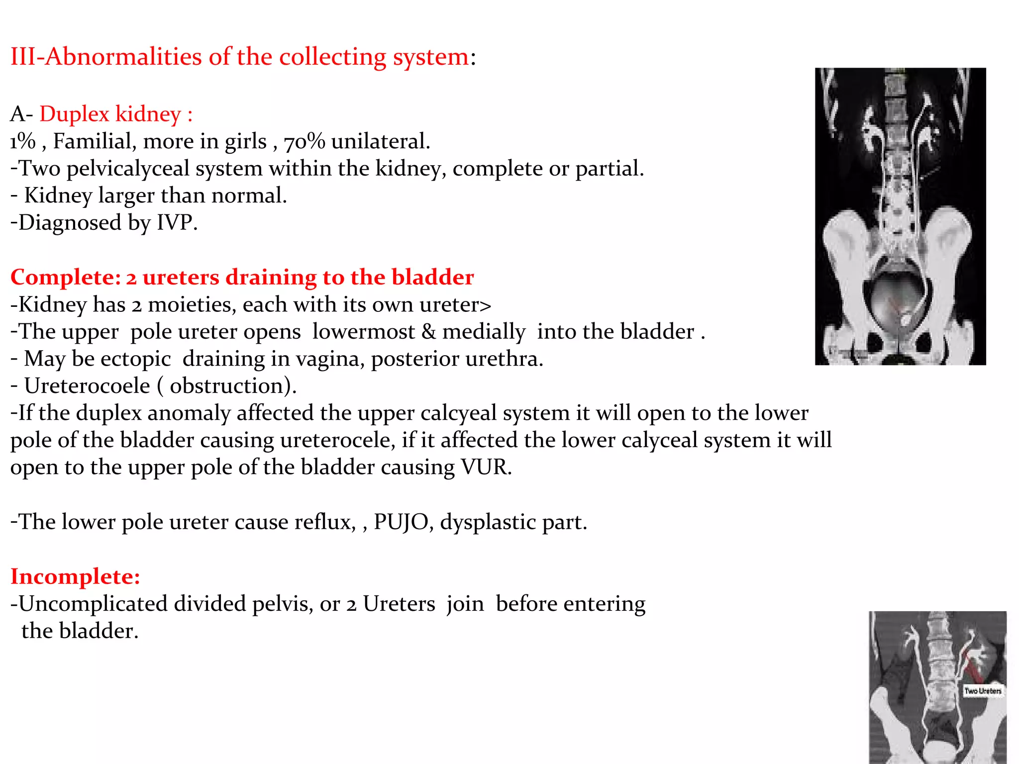 III-Abnormalities of the collecting system:
A- Duplex kidney :
1% , Familial, more in girls , 70% unilateral.
-Two pelvicalyceal system within the kidney, complete or partial.
- Kidney larger than normal.
-Diagnosed by IVP.
Complete: 2 ureters draining to the bladder
-Kidney has 2 moieties, each with its own ureter>
-The upper pole ureter opens lowermost & medially into the bladder .
- May be ectopic draining in vagina, posterior urethra.
- Ureterocoele ( obstruction).
-If the duplex anomaly affected the upper calcyeal system it will open to the lower
pole of the bladder causing ureterocele, if it affected the lower calyceal system it will
open to the upper pole of the bladder causing VUR.
-The lower pole ureter cause reflux, , PUJO, dysplastic part.
Incomplete:
-Uncomplicated divided pelvis, or 2 Ureters join before entering
the bladder.
 