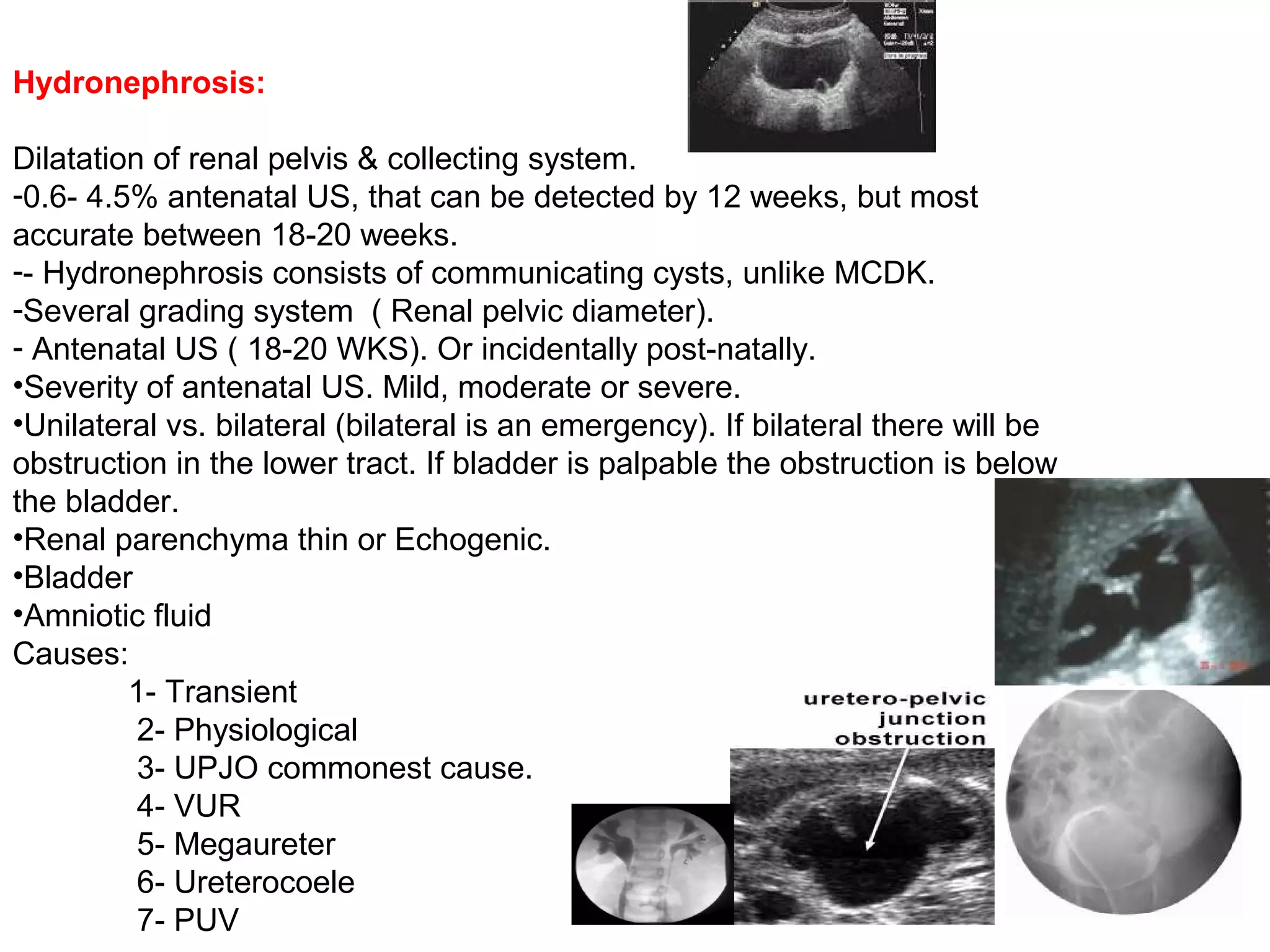 Hydronephrosis:
Dilatation of renal pelvis & collecting system.
-0.6- 4.5% antenatal US, that can be detected by 12 weeks, but most
accurate between 18-20 weeks.
-- Hydronephrosis consists of communicating cysts, unlike MCDK.
-Several grading system ( Renal pelvic diameter).
- Antenatal US ( 18-20 WKS). Or incidentally post-natally.
•Severity of antenatal US. Mild, moderate or severe.
•Unilateral vs. bilateral (bilateral is an emergency). If bilateral there will be
obstruction in the lower tract. If bladder is palpable the obstruction is below
the bladder.
•Renal parenchyma thin or Echogenic.
•Bladder
•Amniotic fluid
Causes:
1- Transient
2- Physiological
3- UPJO commonest cause.
4- VUR
5- Megaureter
6- Ureterocoele
7- PUV
 