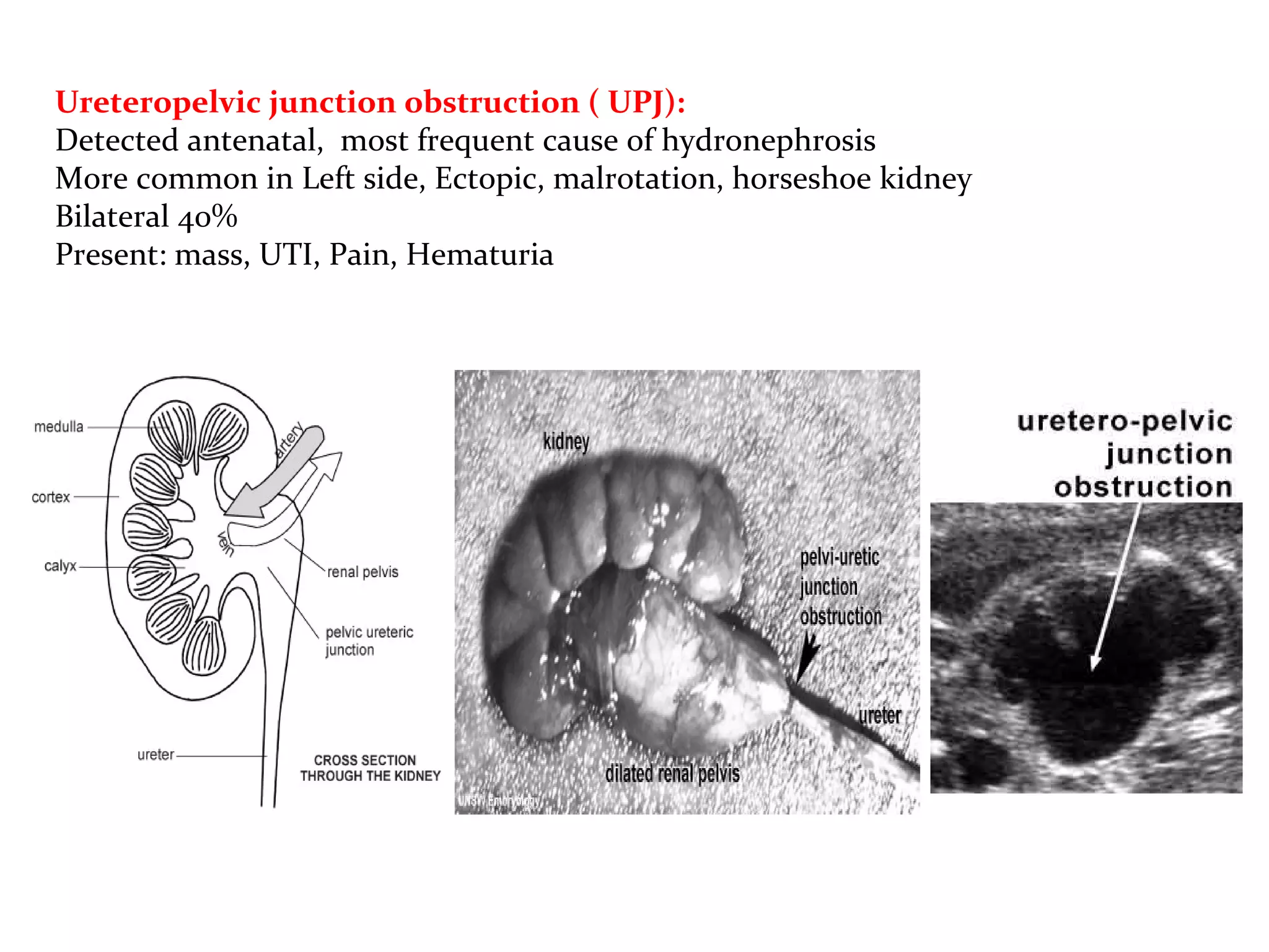 Ureteropelvic junction obstruction ( UPJ):
Detected antenatal, most frequent cause of hydronephrosis
More common in Left side, Ectopic, malrotation, horseshoe kidney
Bilateral 40%
Present: mass, UTI, Pain, Hematuria
 