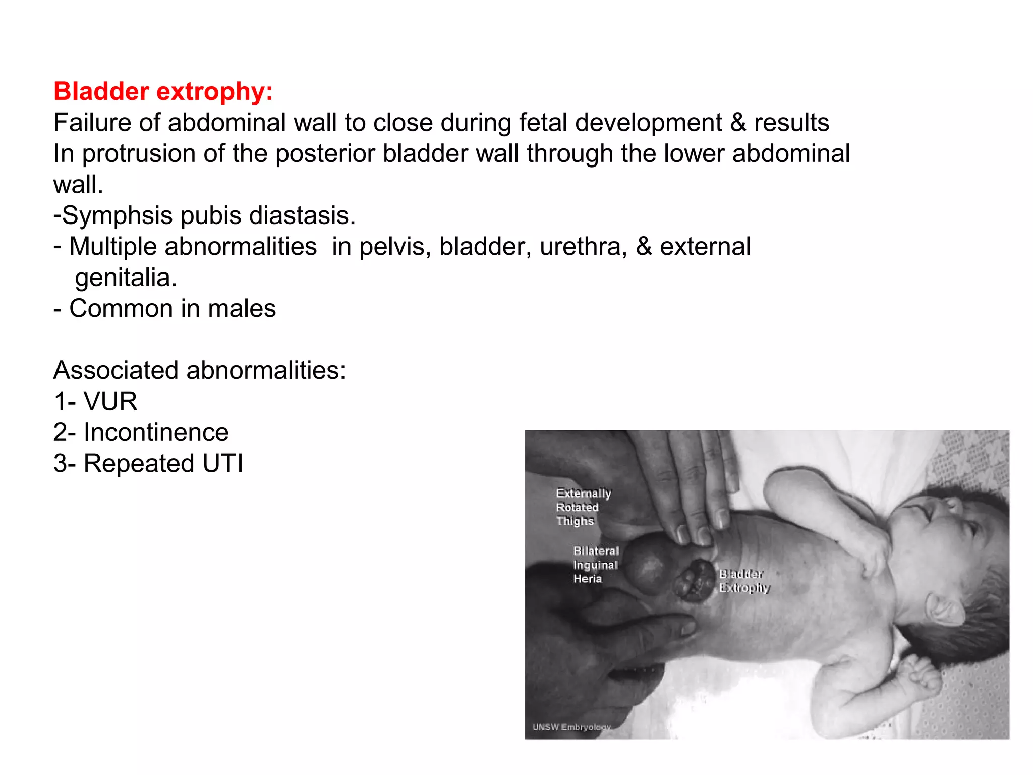 Bladder extrophy:
Failure of abdominal wall to close during fetal development & results
In protrusion of the posterior bladder wall through the lower abdominal
wall.
-Symphsis pubis diastasis.
- Multiple abnormalities in pelvis, bladder, urethra, & external
genitalia.
- Common in males
Associated abnormalities:
1- VUR
2- Incontinence
3- Repeated UTI
 
