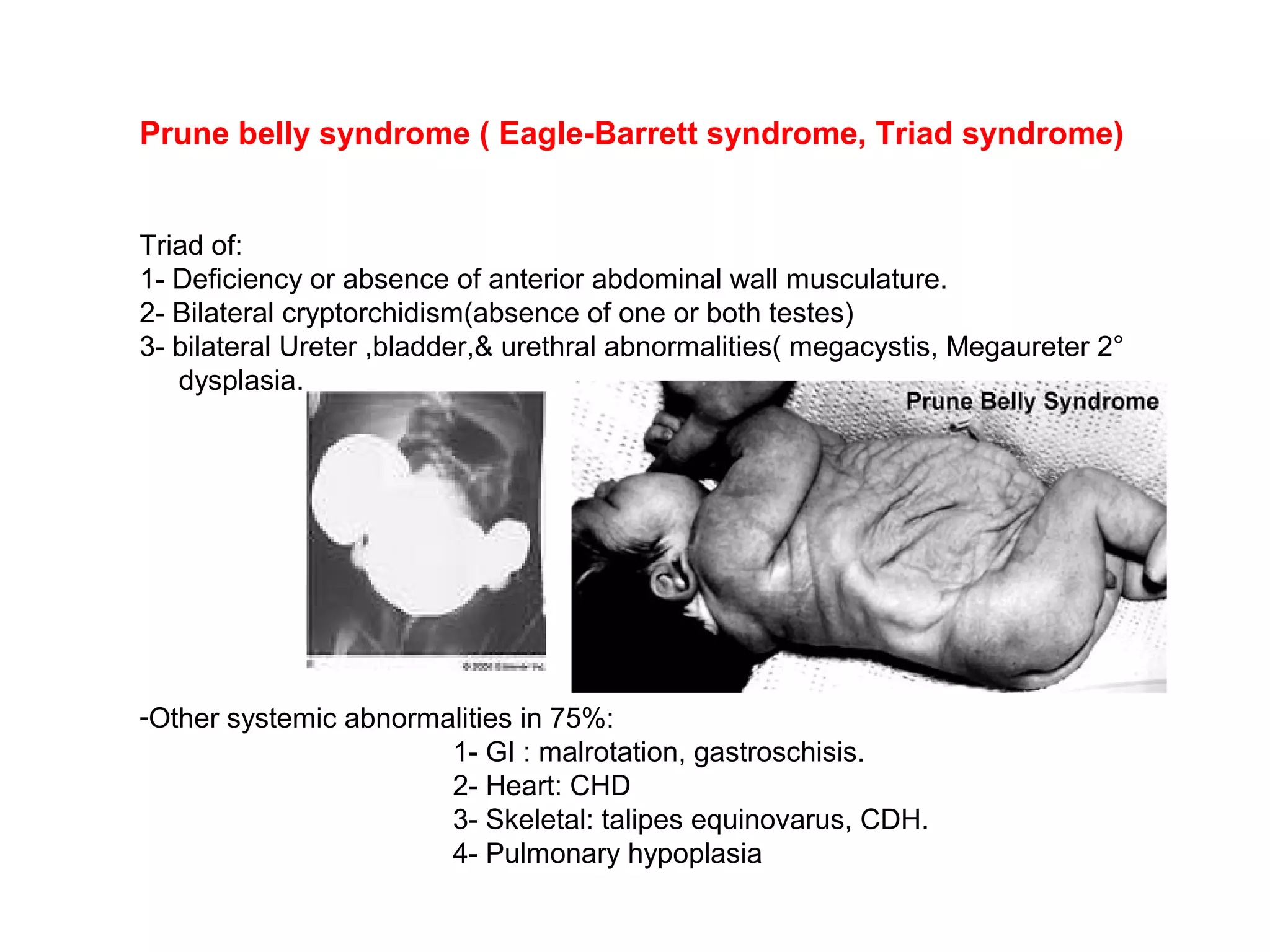 Prune belly syndrome ( Eagle-Barrett syndrome, Triad syndrome)
Triad of:
1- Deficiency or absence of anterior abdominal wall musculature.
2- Bilateral cryptorchidism(absence of one or both testes)
3- bilateral Ureter ,bladder,& urethral abnormalities( megacystis, Megaureter 2°
dysplasia.
-Other systemic abnormalities in 75%:
1- GI : malrotation, gastroschisis.
2- Heart: CHD
3- Skeletal: talipes equinovarus, CDH.
4- Pulmonary hypoplasia
 