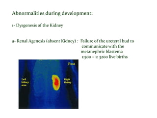 Abnormalities during development:
1- Dysgenesis of the Kidney
a- Renal Agenesis (absent Kidney) : Failure of the ureteral bud to
communicate with the
metanephric blastema
1:500 – 1: 3200 live births
 