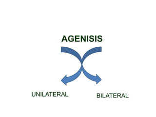 AGENISIS
UNILATERAL BILATERAL
 