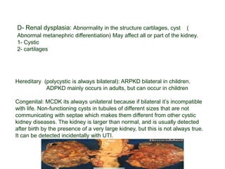 D- Renal dysplasia: Abnormality in the structure cartilages, cyst (
Abnormal metanephric differentiation) May affect all or part of the kidney.
1- Cystic
2- cartilages
Hereditary (polycystic is always bilateral): ARPKD bilateral in children.
ADPKD mainly occurs in adults, but can occur in children
Congenital: MCDK its always unilateral because if bilateral it’s incompatible
with life. Non-functioning cysts in tubules of different sizes that are not
communicating with septae which makes them different from other cystic
kidney diseases. The kidney is larger than normal, and is usually detected
after birth by the presence of a very large kidney, but this is not always true.
It can be detected incidentally with UTI.
 