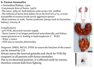 b- Fusion Anomalies
1- horseshoe Kidney: 1:500
-Commonest form of fusion (95%).
-The lower poles of both kidneys unite across the midline
-The isthmus of horse shoe kidney lie at the level of L4-L5, is more
susceptible to trauma (avoid severe aggressive sports)
-More common in male, Turner syndrome (always look for horseshoe
kidney), trisomy 18
Complications:
-50% VUR, abnormal vascular supply.
- Stone (ureter is no longer positioned anterolaterally, and kidney
causes pressure on it, leading to hydronephrosis 2° PUJO.
- Wilm’s tumor
- HTN due to vascular abnormality.
Diagnosis: DMSA, MCUG ,DTPA (to assess the function of the ureter)
can be missed by U/S.
Always assess the external genitalia and check for VUR (by
urogram) in all patients with fusion anomalies.
Due to its abnormal position, it is affected easily by trauma,
therefore restrain kids from fighting
 