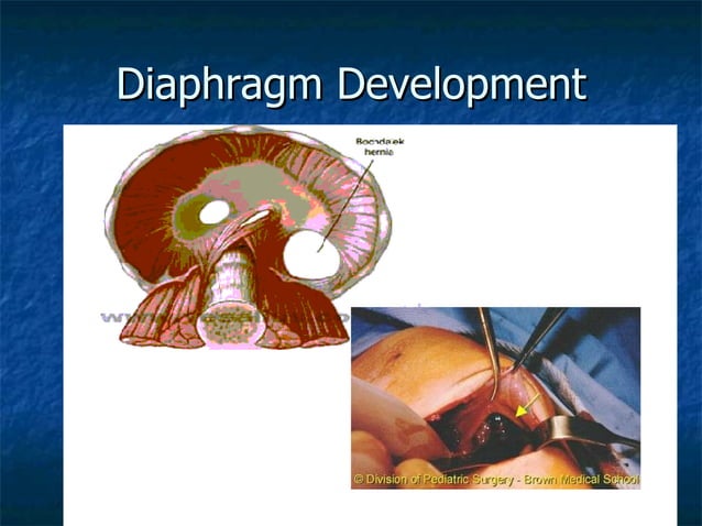 Congenital Diaphragmatic Hernia Ppt