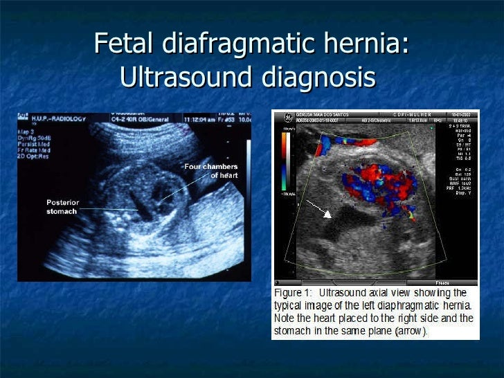 congenital-diaphragmatic-hernia