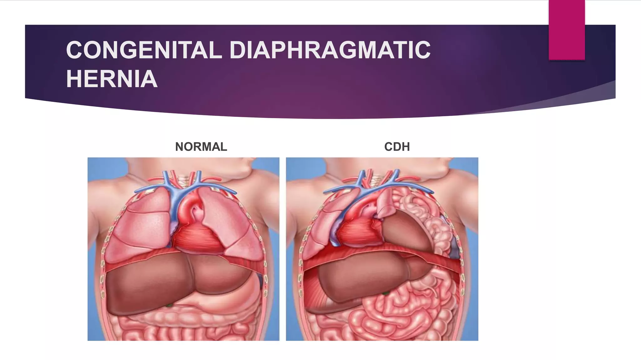 Congenital Diaphragmatic Hernia | PPTX