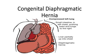 Congenital Diaphragmatic
Hernia
 