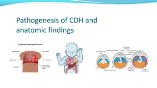 Pathogenesis of CDH and
anatomic findings
 