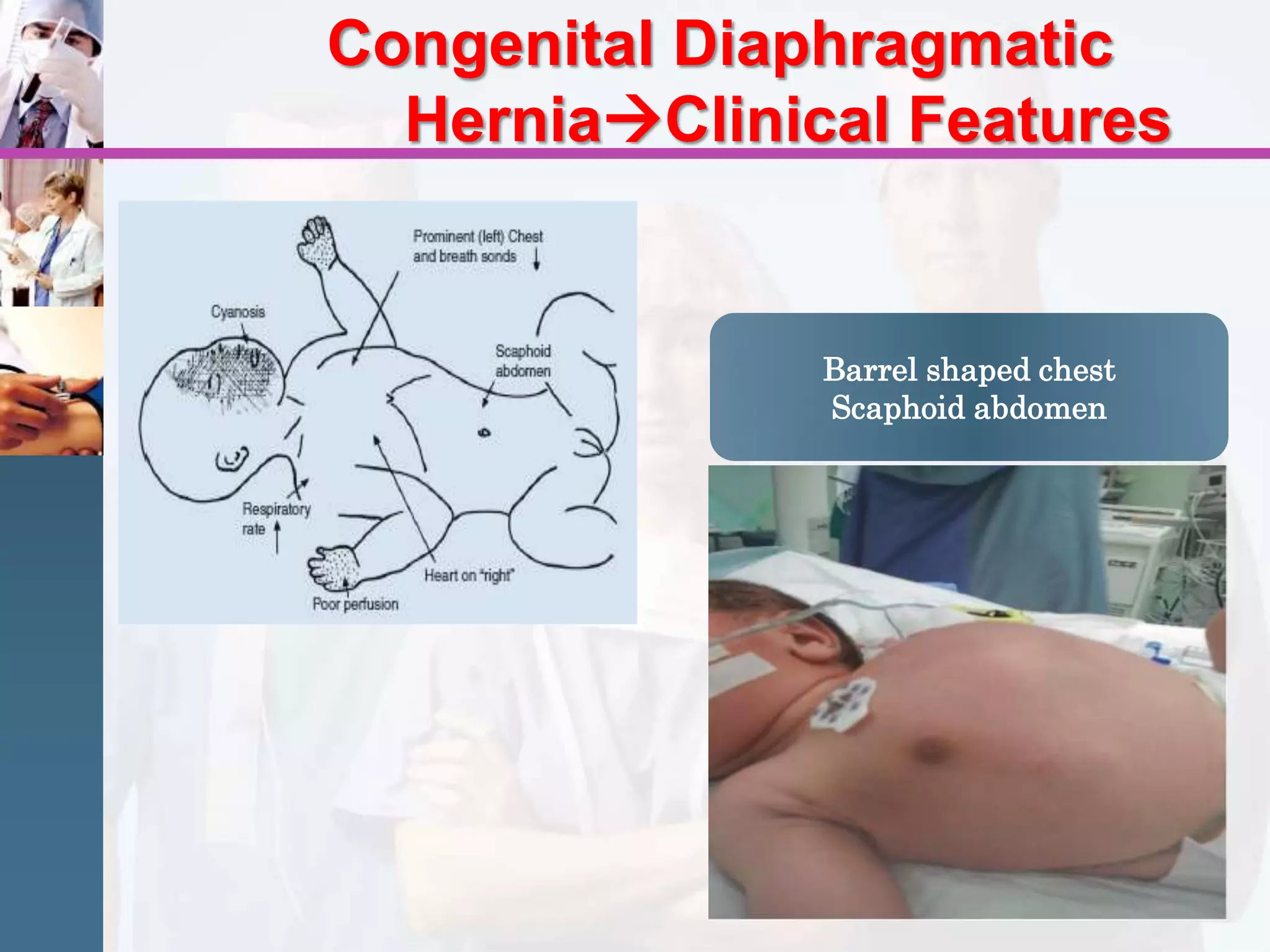 Congenital diaphragmatic hernia / Pediatric surgery | PPT