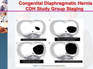 Congenital diaphragmatic hernia / Pediatric surgery | PPT