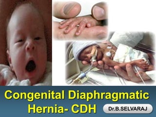 L/O/G/O
Congenital Diaphragmatic
Hernia- CDH Dr.B.SELVARAJ
 