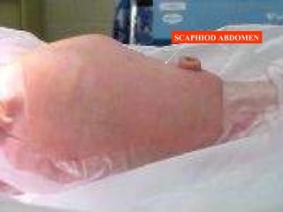SCAPHIOD ABDOMEN 