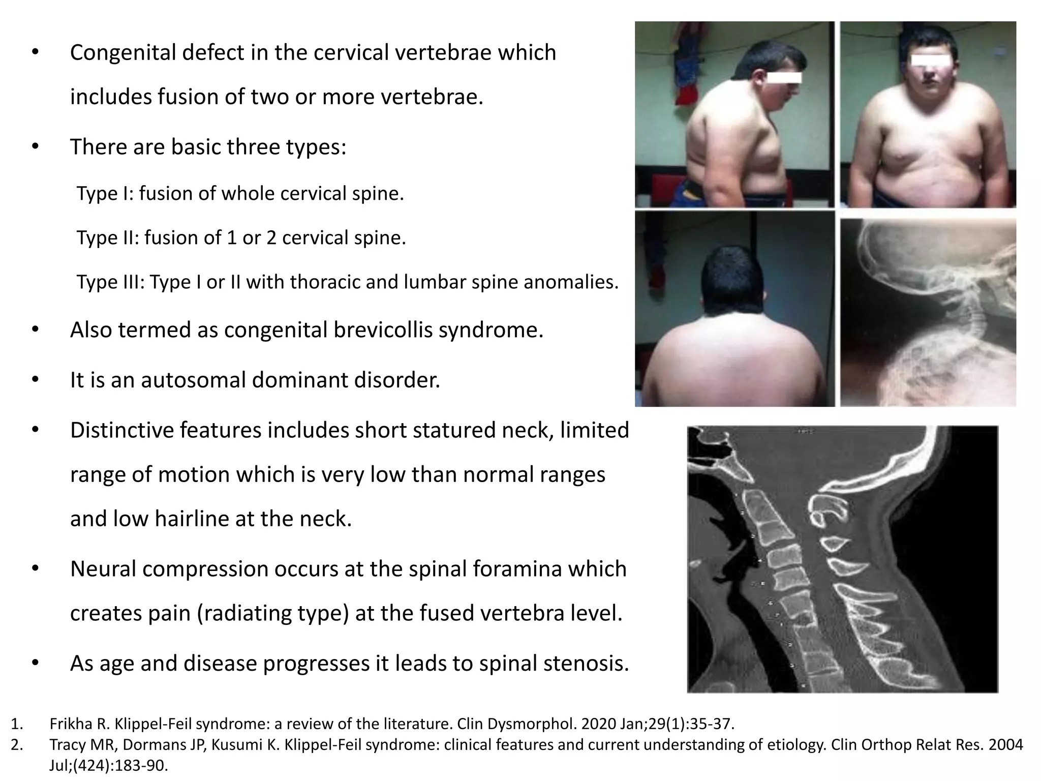 Spinal Defet Congenital diseases causing Spinal Cord Compression | PPTX