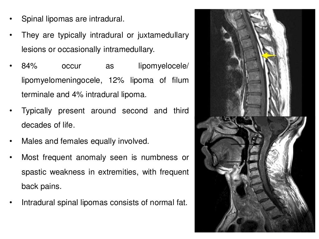 Congenital diseases causing Spinal Cord Compression