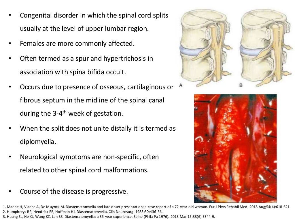 Congenital diseases causing Spinal Cord Compression