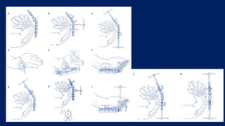 upper limb congenital anomalies | PPTX
