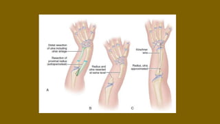 upper limb congenital anomalies | PPTX