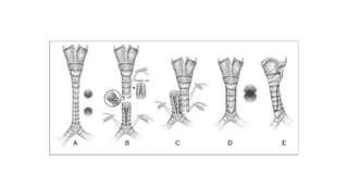 Trachea Dysfunction CONGENITAL DISORDERS OF LARYNX,TRACHEA AND BRONCHI.pptx