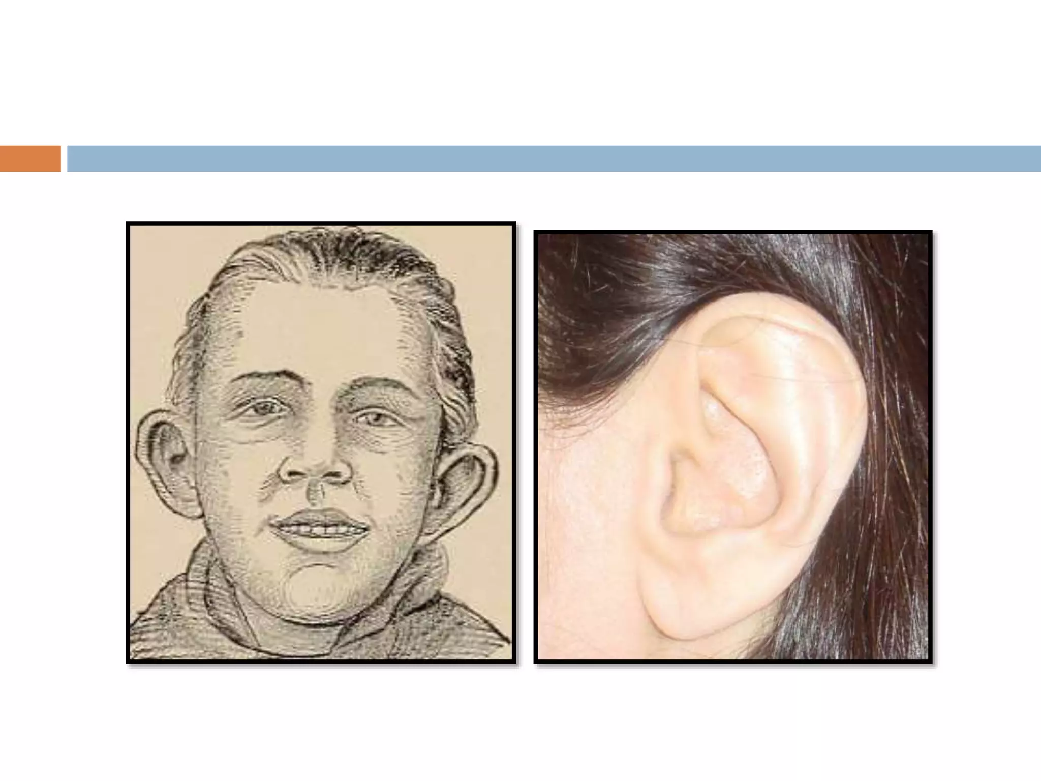 Congenital ear deformities | PPTX