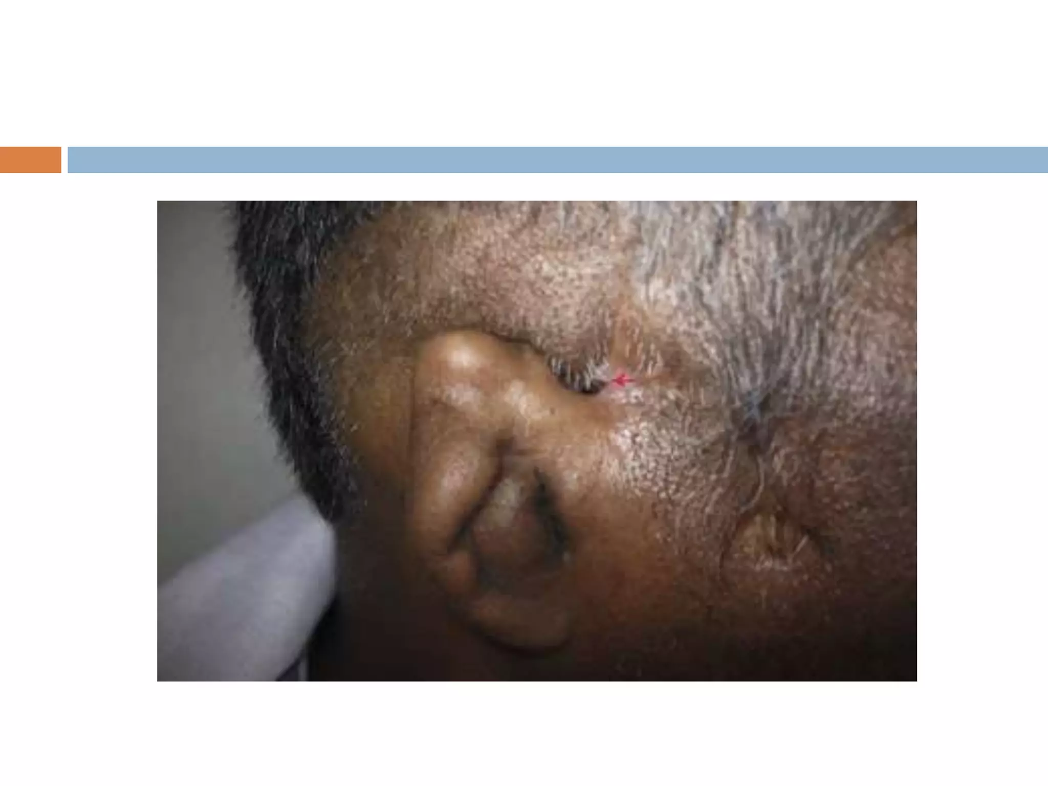 Congenital ear deformities | PPTX