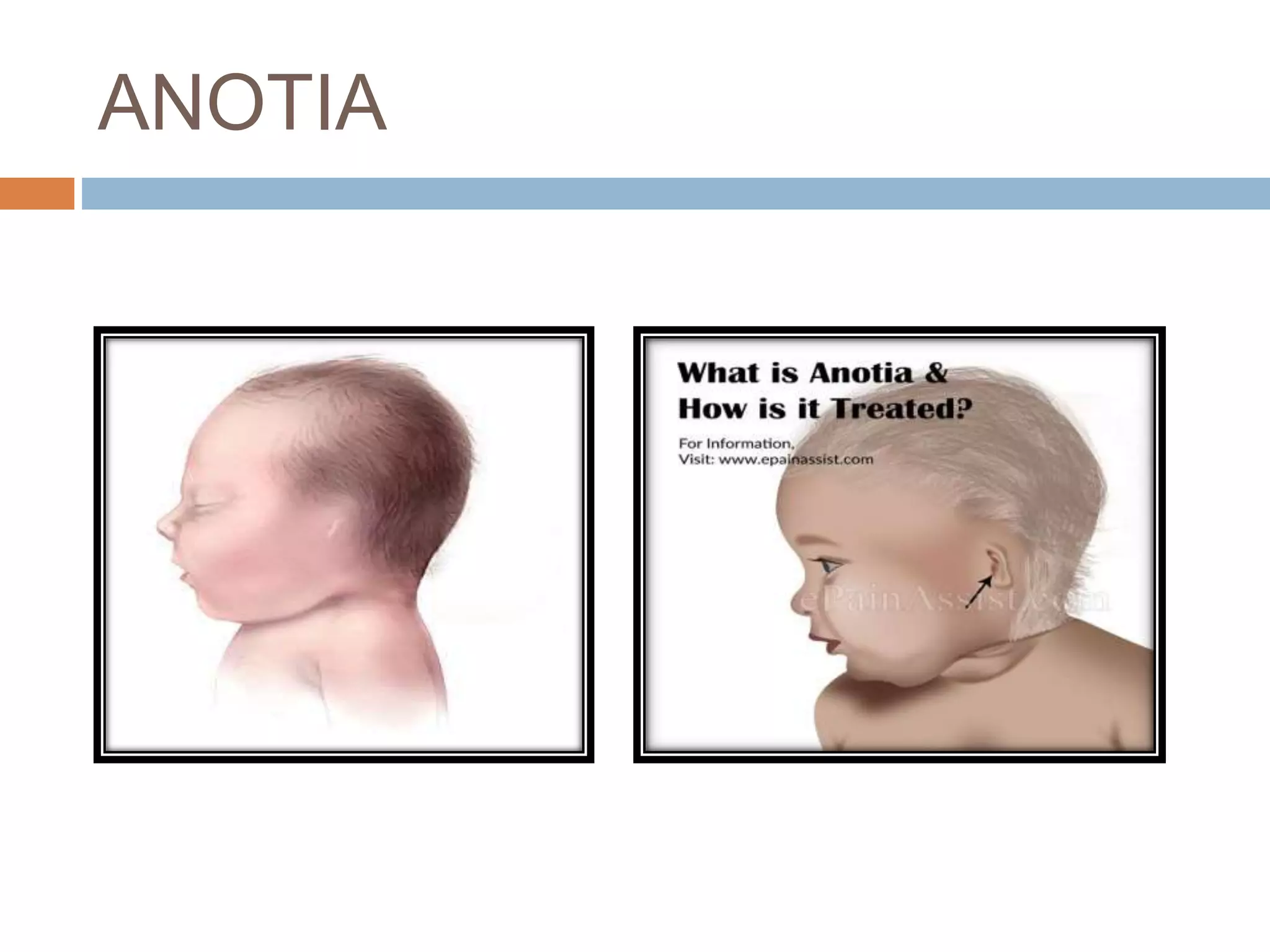 Congenital ear deformities | PPTX