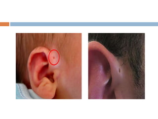 Congenital ear deformities | PPTX