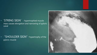 String. Sign Vertebral Congenital gastrointestinal anomalies | PPTX