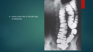 Colon Defect Congenital gastrointestinal anomalies | PPTX
