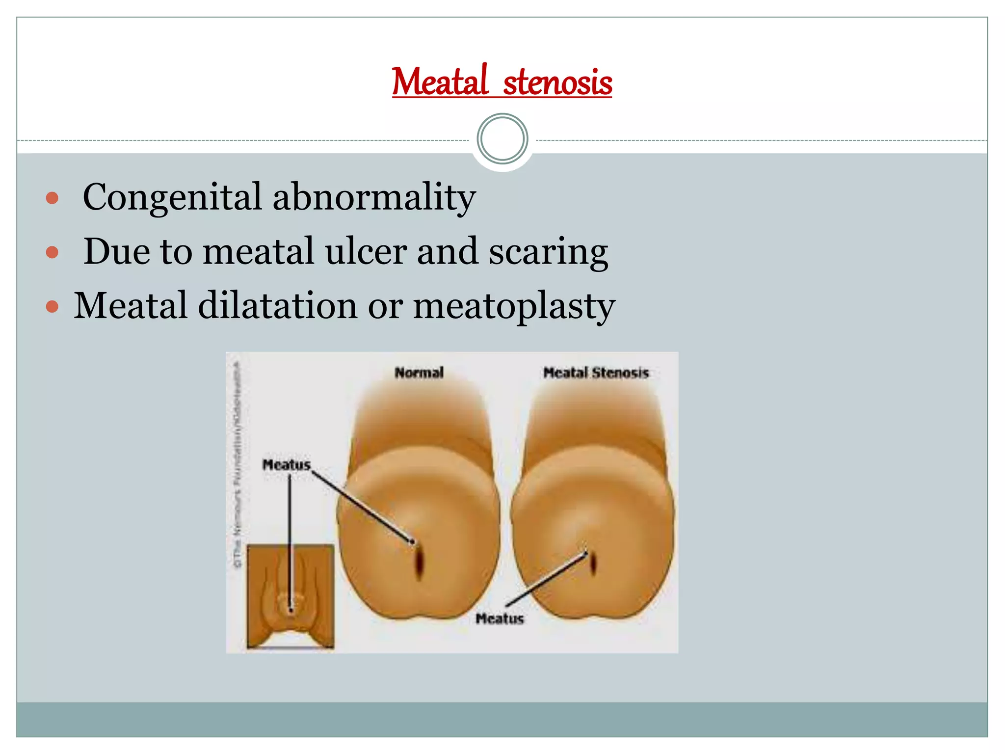 Congenital Genito Urinary Disorders PPTX congenital-genito-urinary-disorders-pptx