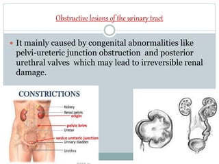 Obstructive lesions of the urinary tract
 It mainly caused by congenital abnormalities like
pelvi-ureteric junction obstruction and posterior
urethral valves which may lead to irreversible renal
damage.
 