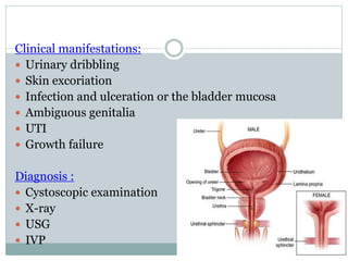 Clinical manifestations:
 Urinary dribbling
 Skin excoriation
 Infection and ulceration or the bladder mucosa
 Ambiguous genitalia
 UTI
 Growth failure
Diagnosis :
 Cystoscopic examination
 X-ray
 USG
 IVP
 
