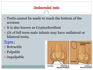 Undescended testis
 Testis cannot be made to reach the bottom of the
scrotum
 It is also known as Cryptochordism
 5% of full term male infants may have unilateral or
bilateral testis.
Types :
 Retractile
 Palpable
 impalpable
 