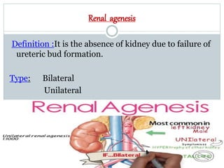 Renal agenesis
Definition :It is the absence of kidney due to failure of
ureteric bud formation.
Type: Bilateral
Unilateral
 