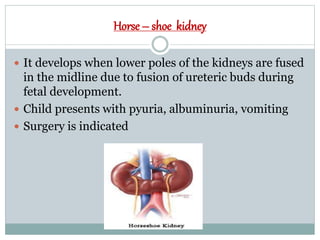 Horse – shoe kidney
 It develops when lower poles of the kidneys are fused
in the midline due to fusion of ureteric buds during
fetal development.
 Child presents with pyuria, albuminuria, vomiting
 Surgery is indicated
 
