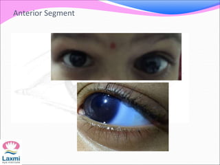 Anterior Segment
 