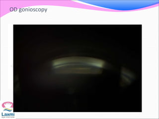 OD gonioscopy
 